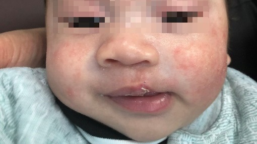 Điều trị tiền phẫu thuật cho trẻ mắc dị tật khe hở môi – vòm miệng