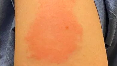 Phản ứng da thường gặp sau tiêm vaccine COVID-19